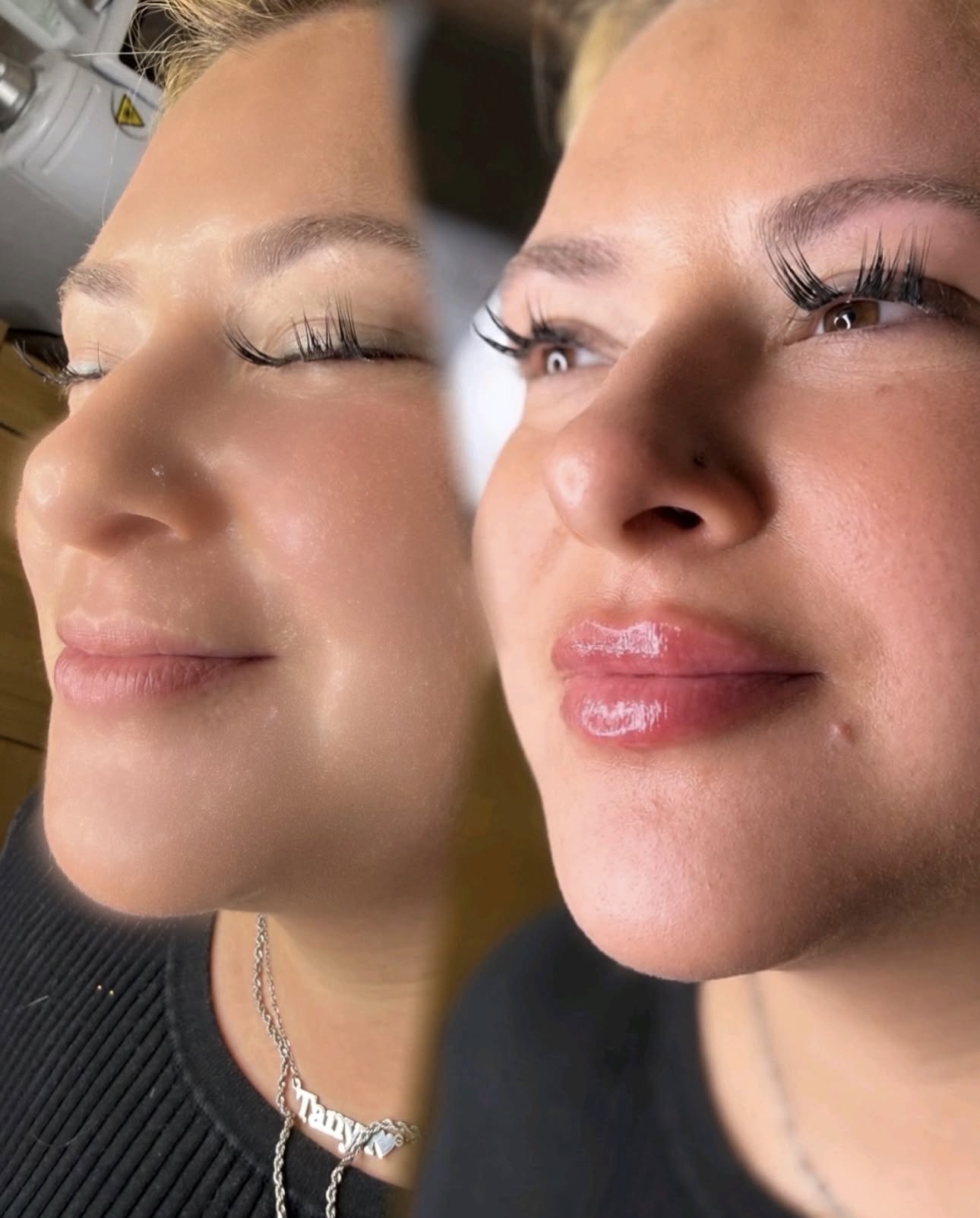 Dolls Lounge Lip Enhancement client result