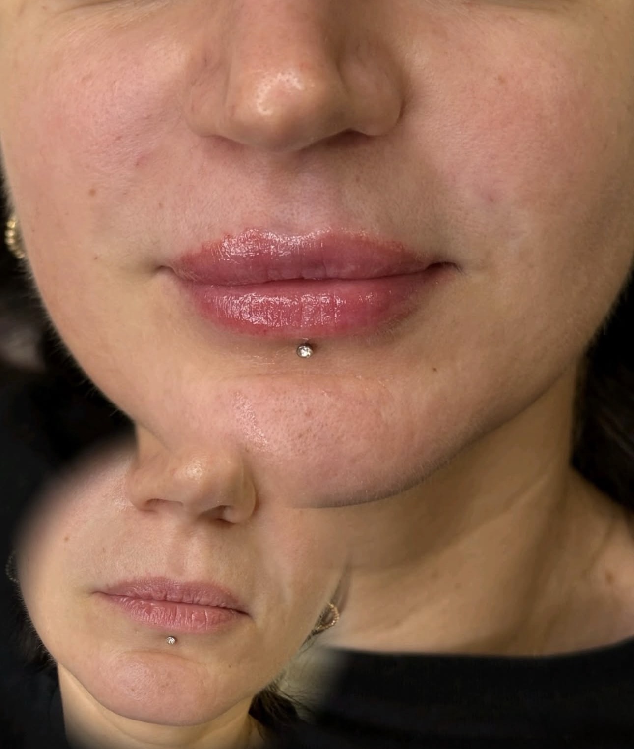 Dolls Lounge Facial Filler client result