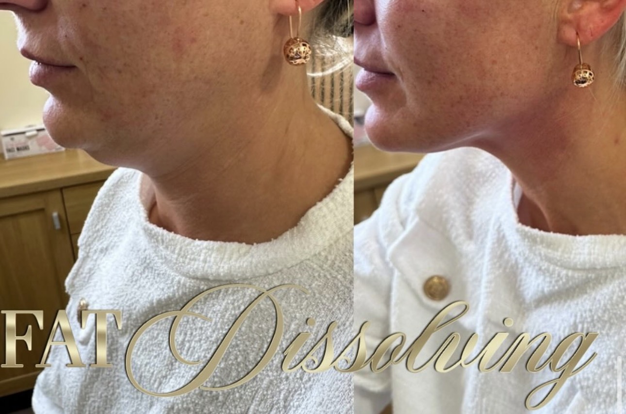 Genuine Dolls Lounge client before and after result 7
